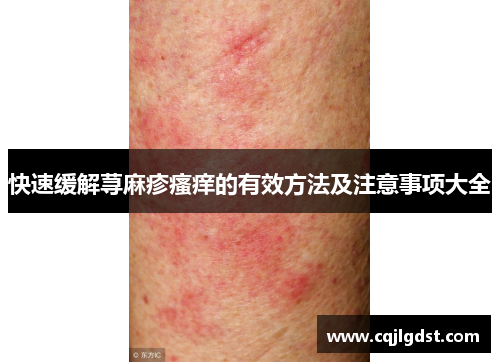 快速缓解荨麻疹瘙痒的有效方法及注意事项大全
